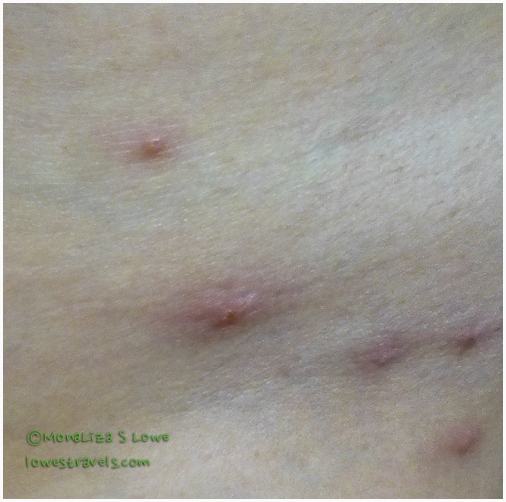 Chigger Bites